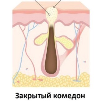 Как избавиться от закрытых комедонов Как избавиться от закрытых комедонов