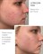 ULTRACLEAR MASK SKINCOUTURE | Маска для проблемной кожи лица До / После