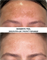 SKINBRITE PEEL SKINCOUTURE | Пилинг СКИНБРАЙТ от пигментных пятен до после