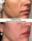 SKINBRITE PEEL SKINCOUTURE | Пилинг СКИНБРАЙТ от пигментных пятен до после