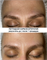 PEPTIDE CARBOXYTHERAPY SKINCOUTURE | Пептидная карбокситерапия до/ после