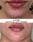 ULTRAPEEL | пилинг УЛЬТРА  против акне и розацеа SKINCOUTURE | до после
