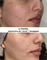 ULTRAPEEL | пилинг УЛЬТРА  против акне и розацеа SKINCOUTURE | до после