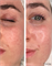 ULTRAPEEL | пилинг УЛЬТРА  против акне и розацеа SKINCOUTURE | до после