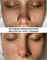 PEPTIDE CARBOXYTHERAPY SKINCOUTURE | Пептидная карбокситерапия до/ после